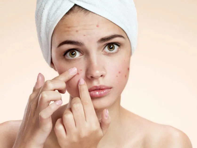  Natural ways to Get Rid of Acne and Pimples | Home remedies and prevention 2021