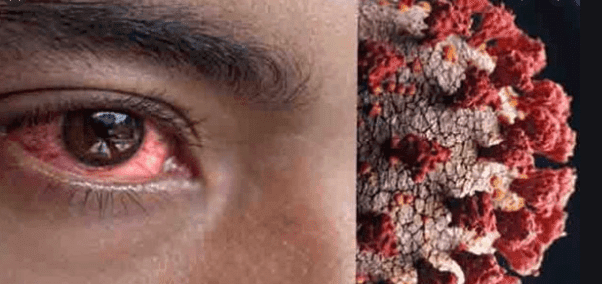 WHAT IS A BLACK FUNGUS IN COVID-19? HOW YOU SHOULD PREVENT YOURSELF FROM IT?