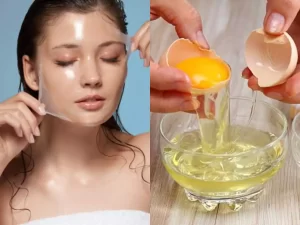 Home remedies for blackheads 5 Home remedies for blackheads