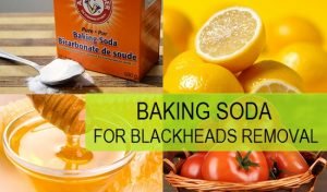 Home remedies for blackheads 1 Home remedies for blackheads