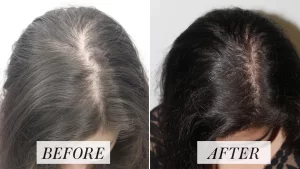 Hair growth