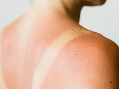 How to stay away from sunburn