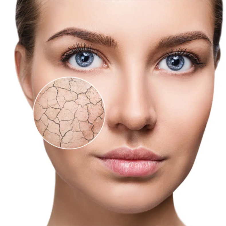 DRY SKIN TYPE